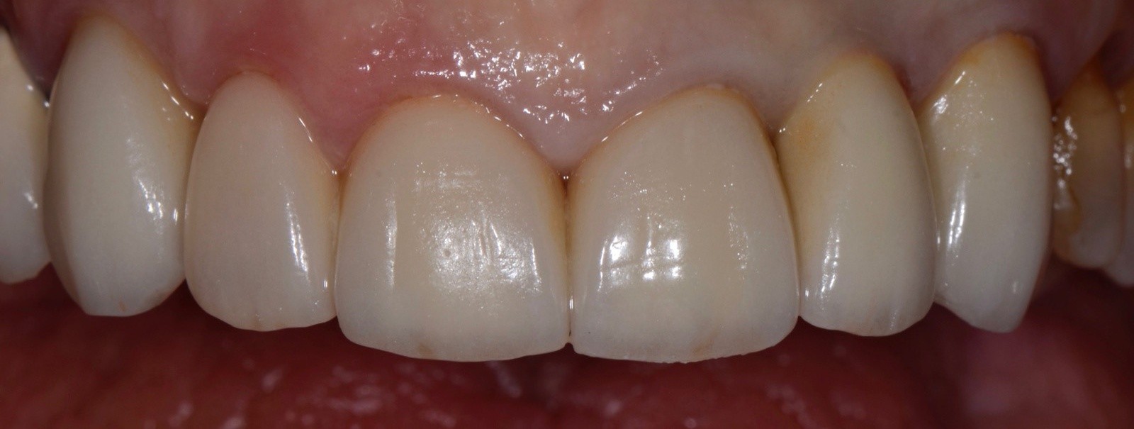 Ceramic Crowns