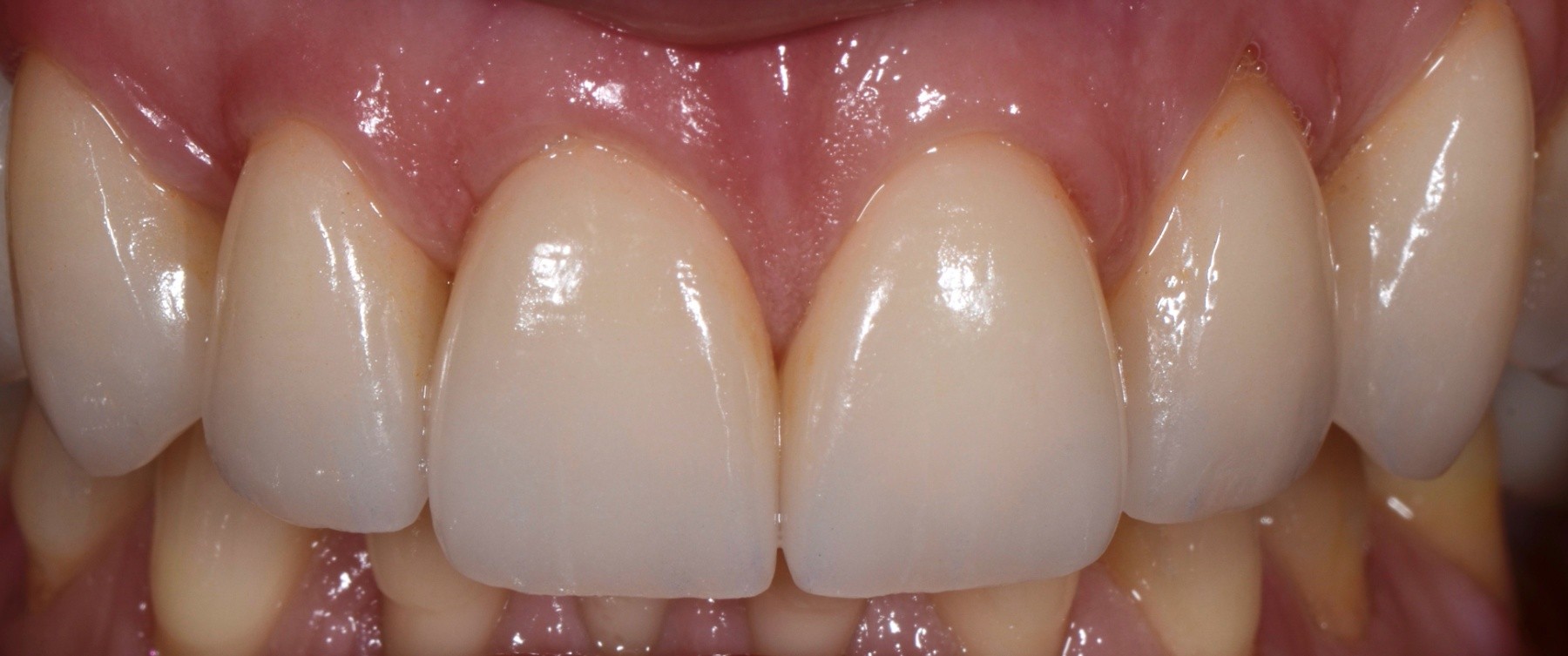 Ceramic Veneers