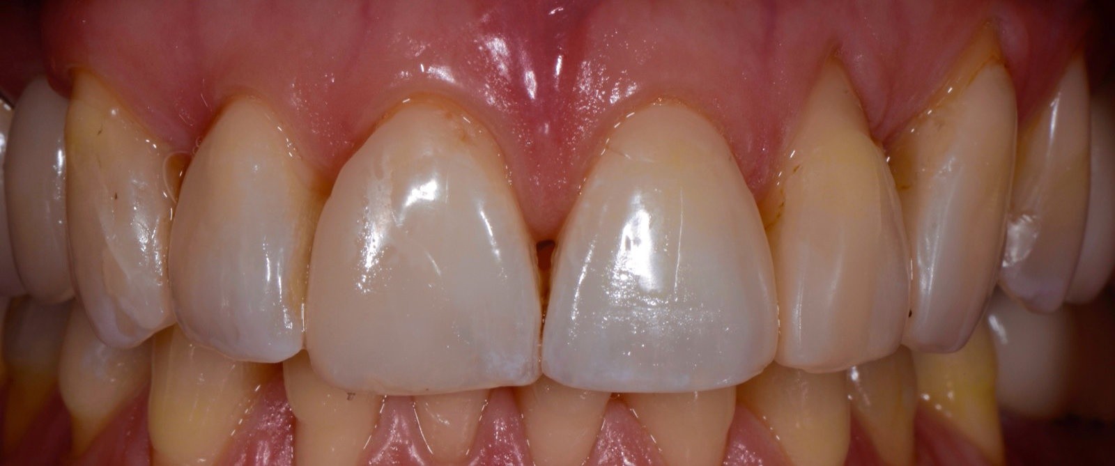 Ceramic Veneers