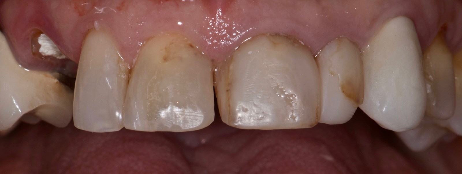 Ceramic Crowns